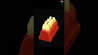 iDENTical Caries Model M4013  Dental Caries Teaching Aid for Patient Education shorts [upl. by Dygall]