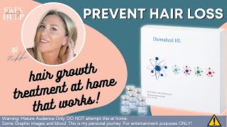 Microneedling DermaHeal HL for HAIR GROWTH [upl. by Lauer]