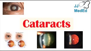 Cataracts  Causes Risk factors Subtypes Cortical Nuclear Posterior subcapsular Treatment [upl. by Rednave]