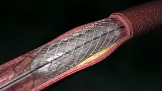 Coronary Artery Angioplasty  Radial Access [upl. by Crockett589]