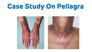 Case Study On Pellagra  Biochemistry Case Study  Pellagra B3 Deficiency [upl. by Ahsiret]