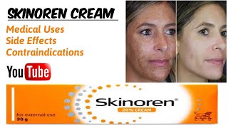 Skinoren Cream  Medical Uses  Face Whitening Agent [upl. by Zenitram]