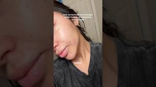 How my hormonal acne changes within 3 weeks of using turmeric soap skincare acnetreatment [upl. by Arahk]