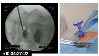 Vertebroplasty under local anesthesia  2nd video [upl. by Kurtzman106]