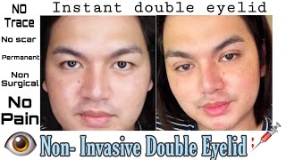 Non Invasive Double Eyelid Procedure  No Surgery No Scar  Bryan Bartolay [upl. by Ytisahcal]