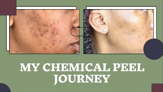 Chemical Peel Journey  Hyperpigmentation on Black Skin  TCA Peel [upl. by Siouxie]