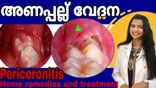 Pericoronitis  അണപ്പല്ല് വേദന  PericoronitisTreatment and home remedies in Malayalam  drshilpa [upl. by Liatris]