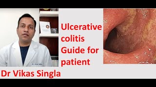 Ulcerative colitis Treatment and Symptoms अल्सरेटिव कोलाइटिस In Hindi Dr Vikas Singla [upl. by Aicele]