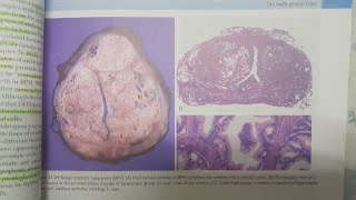 Benign Prostatic Hyperplasia  SPECIAL PATHOLOGY [upl. by Collie361]