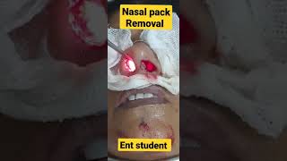 Nasal pack removal [upl. by Johnston]