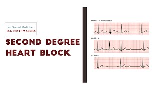 Second degree AV Block  Heart Blocks  ECG Rhythm Series [upl. by Aicnetroh]