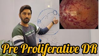 Pre Proliferative diabetic retinopathy [upl. by Lissie]