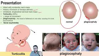 Fibromatosis Colli  pediatric ultrasound  DrMohamed Soliman [upl. by Risa]