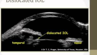 New technologies in Glaucoma UBM [upl. by Gravante]