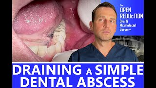 DRAINING a SIMPLE DENTAL ABSCESS [upl. by Hnoj236]