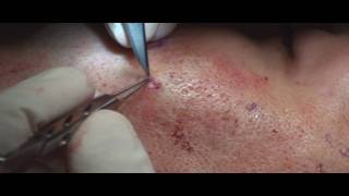 Acne Scar Revision Part 04 More Subcision Technique by Dr Young [upl. by Pisano984]