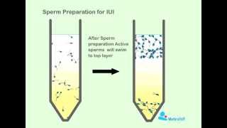 Sperm Preperation For IUI [upl. by Kere]