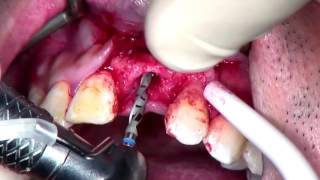 Step by Step Anterior Implant placement with GBR with voiceover [upl. by Zapot]