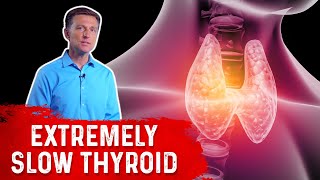 How To Lose Weight With An Extremely Slow Thyroid – DrBerg On Hypothyroidism amp Weight Loss [upl. by Nnail]