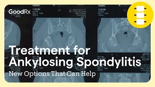 Treatment for Ankylosing Spondylitis New Options That Can Help  GoodRx [upl. by Neladgam]