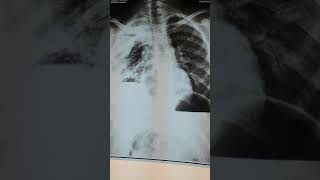 Is it hydropneumothorax really [upl. by Raual259]