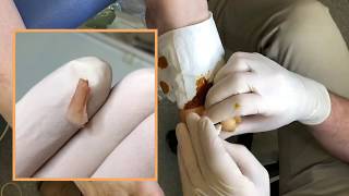 Partial Nail Avulsion Procedure for Ingrown Toenails [upl. by Seavey]