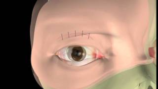 Thyroid eye disease  14 Lid surgery  The operation [upl. by Dunaville]