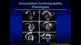 Left Ventricular Non Compaction Cardiomyopathy in Children [upl. by Hamid438]