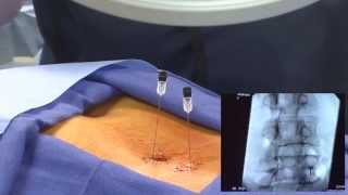 WATCH an Epidural Steroid Injection Demonstration  LIVE [upl. by Kermy]