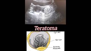 Teratoma  Ovary  Ultrasound  Radiology [upl. by Sinnel738]