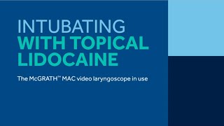 Intubation with Topical Lidocaine and McGrath™ MAC video Laryngoscope [upl. by Aizitel79]