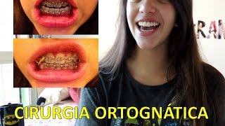 Cirurgia Ortognática  Manual de Sobrevivência Débora Aladim [upl. by Nhtanhoj]