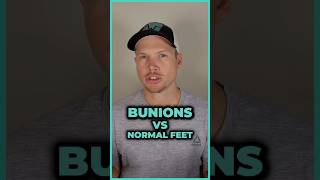 Bunions vs Normal Feet Can Foot Exercises Correct Bunions [upl. by Eicirtap]