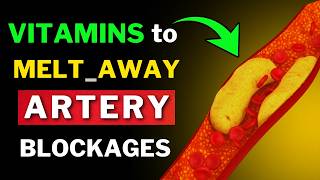 Remove Artery Plaque Naturally 6 Powerful Vitamins [upl. by Toffic]