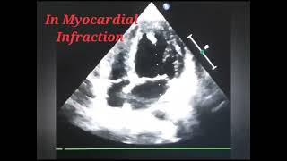 Thrombus in the Apex of Left Ventricular [upl. by Ayota]