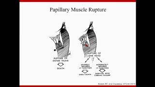 MitraClip Saved My Patient With Cardiogenic Shock  K Dean Boudoulas MD [upl. by Neelehtak23]