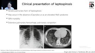 Mini lecture 13 Leptospirosis Clinical presentation amp treatment [upl. by Yeca67]