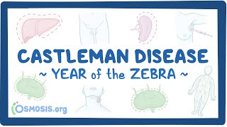 Castleman disease Year of the Zebra [upl. by Maghutte]