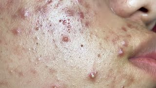 Make your Acne Treatment Huong Da Nang  482 acne 2022 [upl. by Favianus]