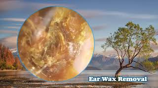 Jam packed ear wax removalWaxvent Ep11 [upl. by Jed219]