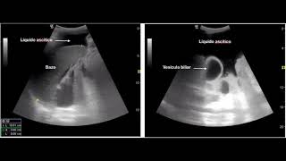 LÍQUIDO INTRAABDOMINAL O LÍQUIDO DE ASCITIS CIRROSIS HIDROPESÍA VALORACIÓN POR ULTRASONIDO [upl. by Parshall]