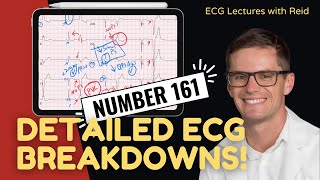 EKG Test Yourself  ECG Case Study 161 [upl. by Halik]