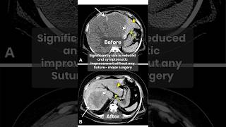 Liver Hemangioma Treatment Embolization Procedure Explained  Dr Amol Lahoti shortsfeed2024 [upl. by Acceber]