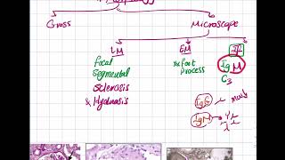 Focal Segmental amp Membranoproliferative GN [upl. by Jacinthe]