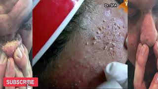 acné severe visage extraction  Dr SPA 15 [upl. by Lekcim]