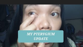 my Pterygium surgery update  beverlylayug [upl. by Adnhoj447]