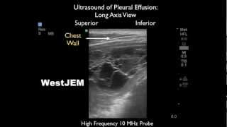 Tuberculous Pleural Effusion [upl. by Imled]