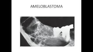 Maxillofacial radiology  MULTILOCULAR RADIOLUCENCY OF JAW [upl. by Lalitta851]