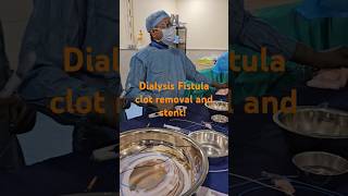 The Fastest Way to Unblock Dialysis Fistula vascularsurgeon shortsyoutube [upl. by Hooge]