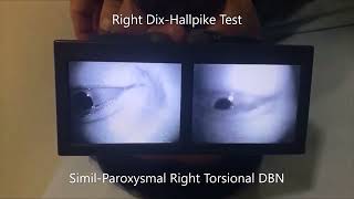 Apogeotropic Left Posterior Semicircular Canal BPPV [upl. by Odrude]